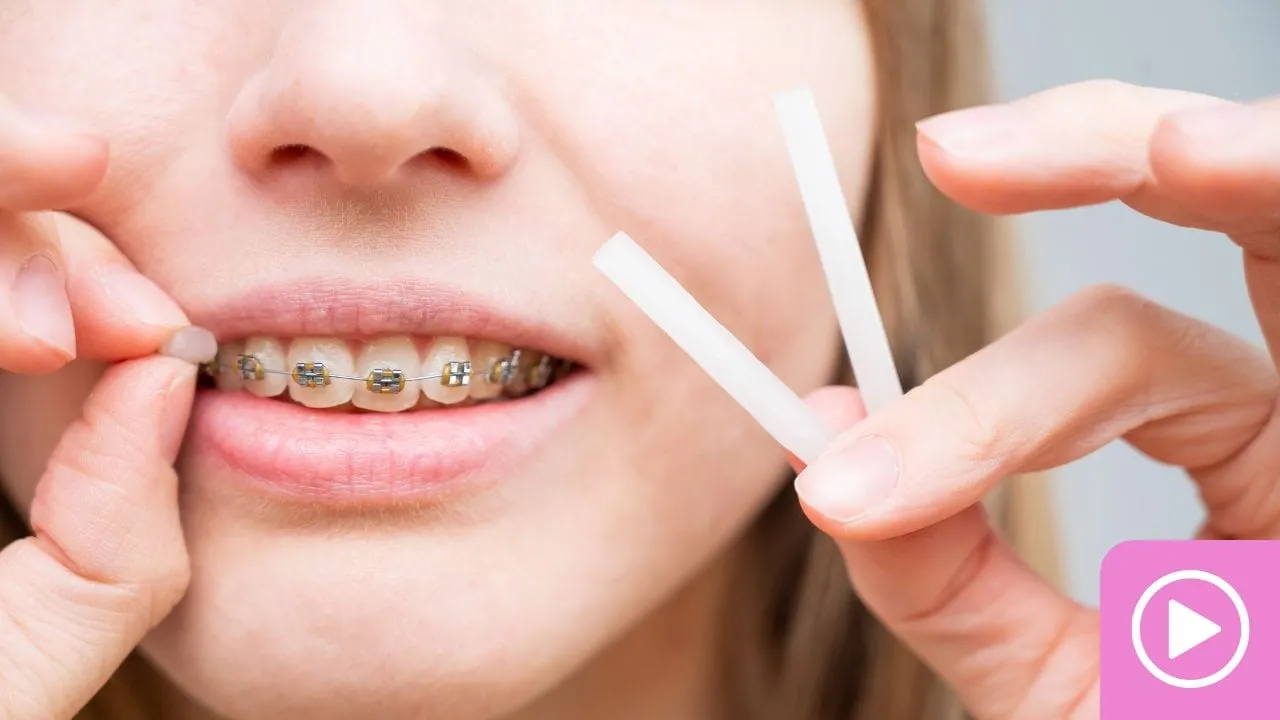 Close-up of a smile with metal braces while an orthodontic elastic is placed.