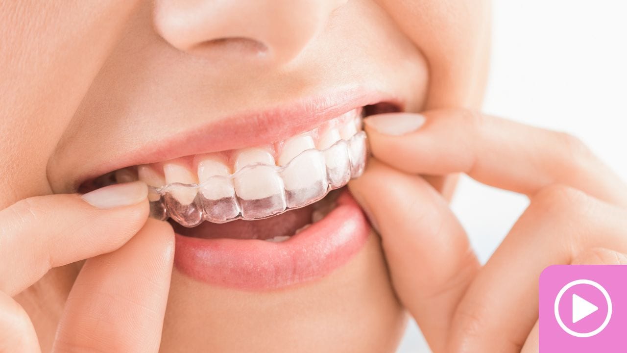 Patient inserting a clear aligner tray over their upper teeth.