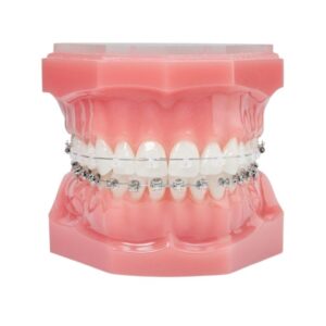 Dental model fitted with traditional metal braces