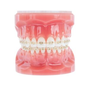 Dental model fitted with clear ceramic braces
