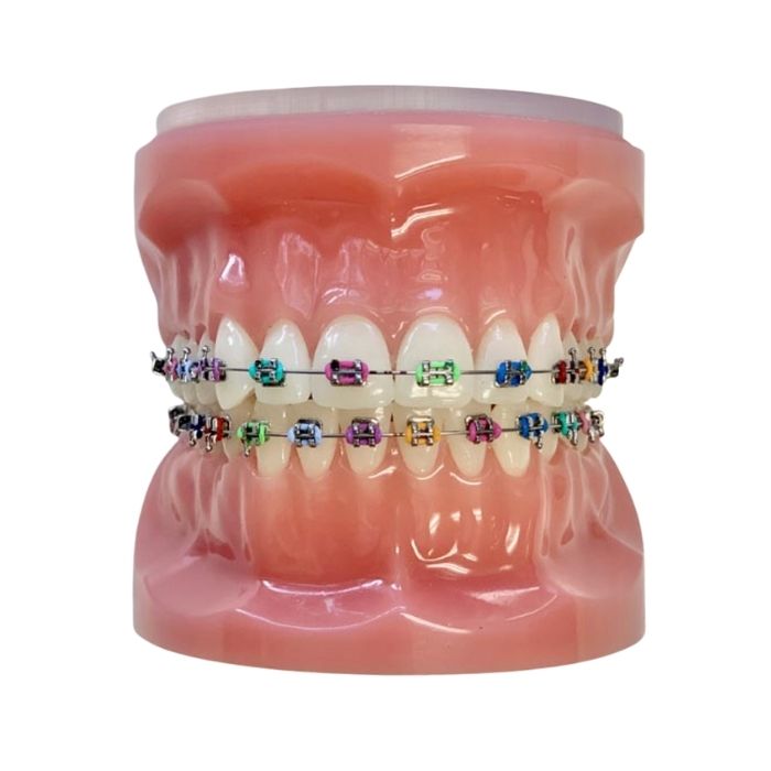 Dental model fitted with braces and colored elastic ties.