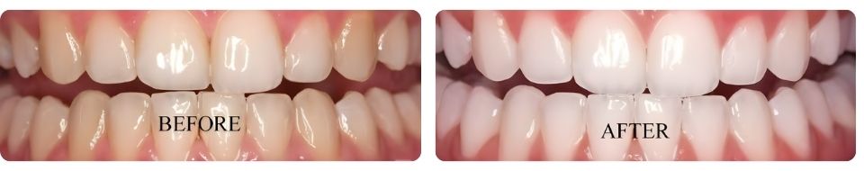 Before-and-after comparison of teeth straightened with orthodontic treatment.