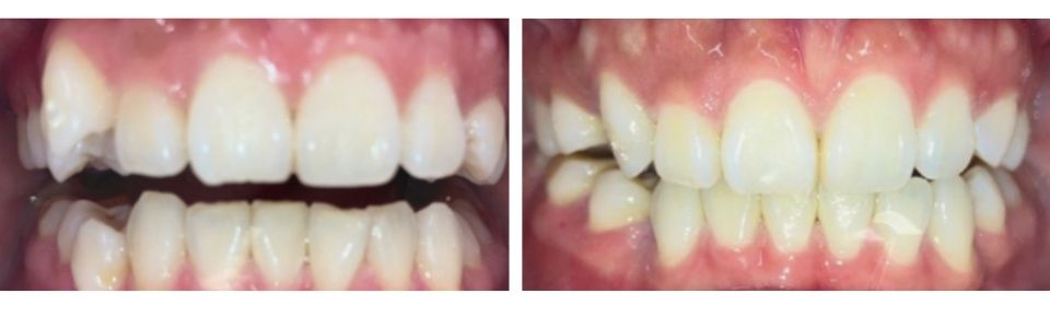 Before and after comparison of crowded teeth straightened with orthodontic treatment.