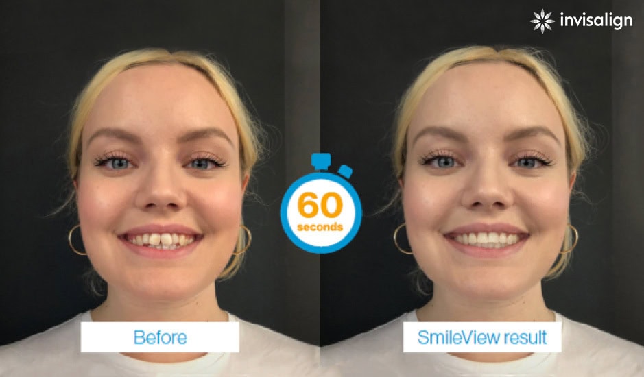 Before and after images of a young woman's smile, showing crooked teeth straightened with Invisalign