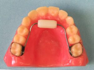 Bluegrass appliance used to stop thumb and tongue habits.