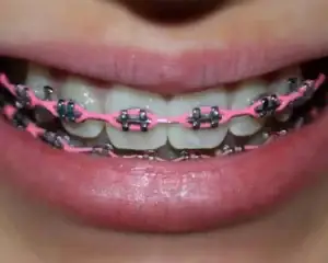 Close-up of braces fitted with power chains to close spacing.