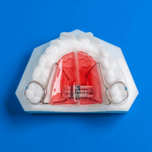 Haas palatal expander appliance used to widen the upper jaw.