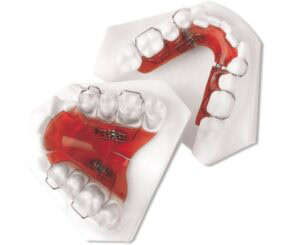 Sagittal expander appliance used to create space in the upper arch.