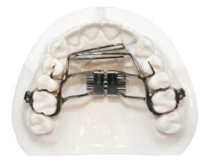 Tongue crib appliance used to correct tongue thrust habits.