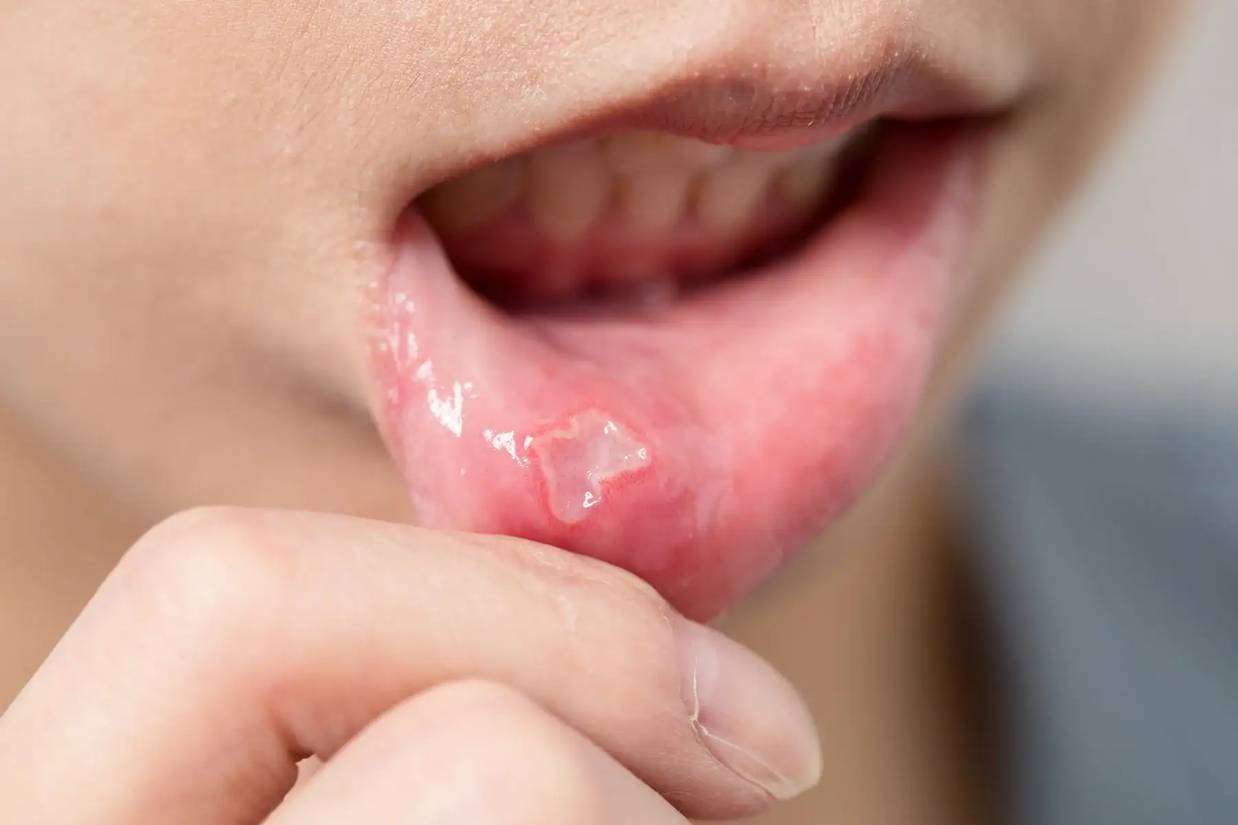 Close-up of a canker sore on the gums