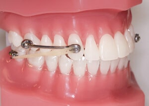 Carriere Motion appliance used to correct bite alignment before braces.