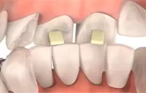 Fixed bite turbos bonded to the teeth to open a deep bite.
