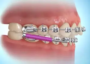 Forsus spring appliance attached to braces to correct an overbite.