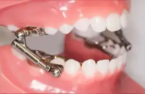 Herbst appliance used to guide lower jaw growth and correct an overbite.