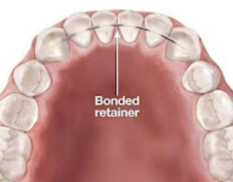Illustration of a bonded retainer fixed behind the upper front teeth.
