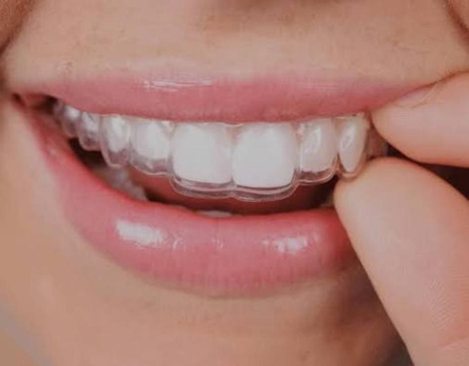 Close-up of a clear aligner being seated over the upper teeth.