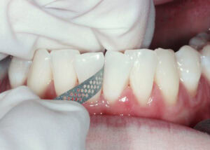 Interproximal reduction (IPR) creating space between crowded teeth.