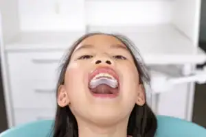 Invisalign Palatal Expander used in early orthodontic treatment for children.