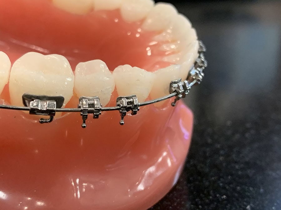 Lost detached brackets