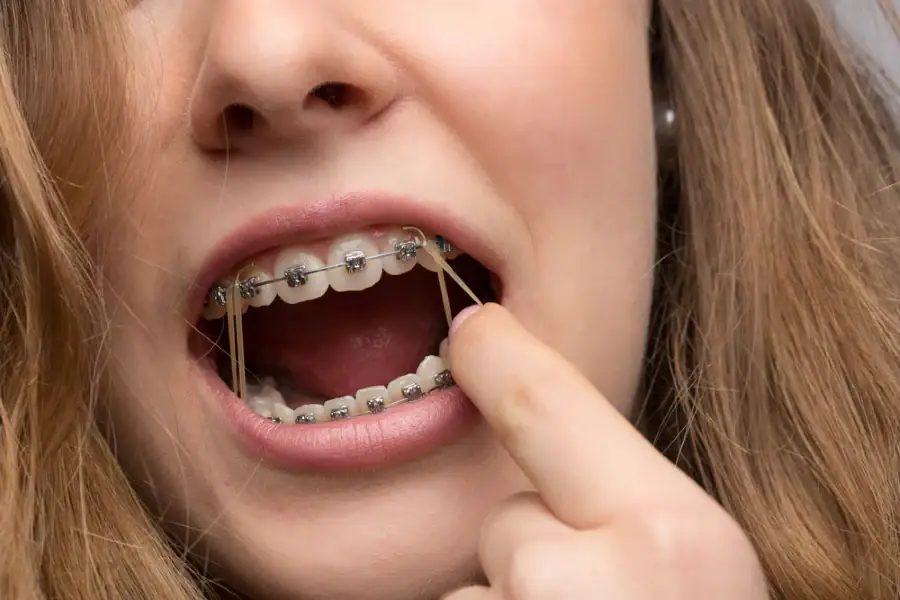 Lost elastic rubber bands
