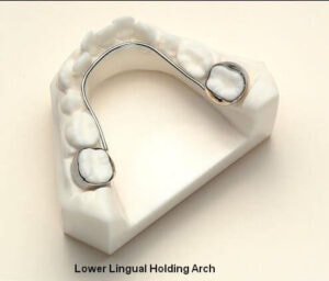 Lower lingual holding arch used to maintain space for permanent teeth.