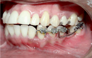 Molar uprighting springs used to straighten tipped molars.
