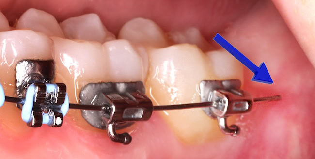Close-up of braces with a wire poking out of place