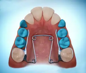 Quad helix expander used to widen the upper arch.