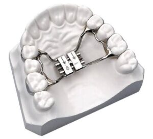 rapid-palatal-expander