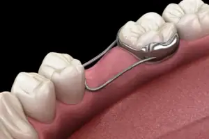 Space maintainer holding room for an erupting permanent tooth.