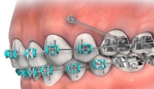 Temporary anchorage device (TAD) used to control tooth movement.