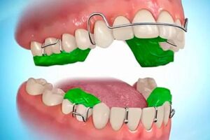 Twin block appliance used to advance the lower jaw in growing patients.