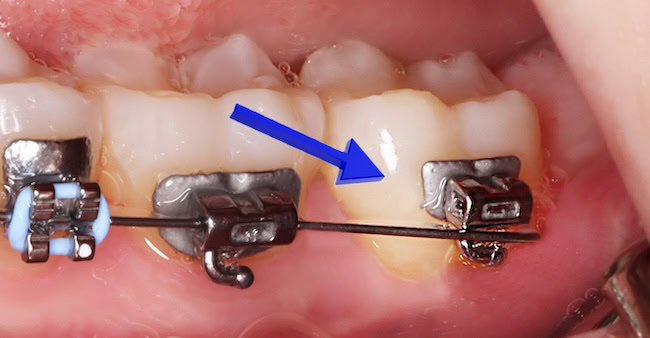 Close-up of a braces wire slipped out of its tube
